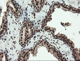 SAMHD1 Antibody - IHC of paraffin-embedded Carcinoma of Human prostate tissue using anti-SAMHD1 mouse monoclonal antibody.