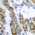 SARS / Serine-tRNA Ligase Antibody - Immunohistochemical analysis of SerRS staining in human gastric cancer formalin fixed paraffin embedded tissue section. The section was pre-treated using heat mediated antigen retrieval with sodium citrate buffer (pH 6.0). The section was then incubated with the antibody at room temperature and detected using an HRP conjugated compact polymer system. DAB was used as the chromogen. The section was then counterstained with hematoxylin and mounted with DPX.