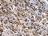 SAV1 / WW45 Antibody - Immunohistochemistry of paraffin-embedded Human gastric cancer tissue  using SAV1 Polyclonal Antibody at dilution of 1:90(×200)
