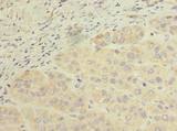 SCFD2 Antibody - Immunohistochemistry of paraffin-embedded human liver cancer using antibody at dilution of 1:100.