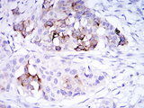 SCGB2A2 / Mammaglobin A Antibody - IHC of paraffin-embedded mammary cancer tissues using SCGB2A2 mouse monoclonal antibody with DAB staining.