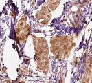 SCGB2A2 / Mammaglobin A Antibody - 1:100 staining human breast carcinoma tissue by IHC-P. The tissue was formaldehyde fixed and a heat mediated antigen retrieval step in citrate buffer was performed. The tissue was then blocked and incubated with the antibody for 1.5 hours at 22°C. An HRP conjugated goat anti-rabbit antibody was used as the secondary.