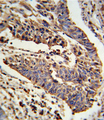 SCNN1A / ENaC Alpha Antibody - Formalin-fixed and paraffin-embedded human lung carcinoma reacted with SCNN1A Antibody , which was peroxidase-conjugated to the secondary antibody, followed by DAB staining. This data demonstrates the use of this antibody for immunohistochemistry; clinical relevance has not been evaluated.