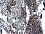 SCRN1 / Secernin 1 Antibody - IHC of paraffin-embedded Carcinoma of Human bladder tissue using anti-SCRN1 mouse monoclonal antibody. (Heat-induced epitope retrieval by 1 mM EDTA in 10mM Tris, pH8.5, 120°C for 3min).