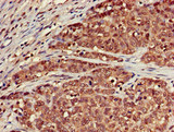 SCTR / SR / Secretin Receptor Antibody - Immunohistochemistry of paraffin-embedded human ovarian cancer at dilution of 1:100