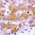 SCYL1 / NTKL Antibody - Immunohistochemical analysis of SCYL1 staining in human liver cancer formalin fixed paraffin embedded tissue section. The section was pre-treated using heat mediated antigen retrieval with sodium citrate buffer (pH 6.0). The section was then incubated with the antibody at room temperature and detected using an HRP conjugated compact polymer system. DAB was used as the chromogen. The section was then counterstained with hematoxylin and mounted with DPX.