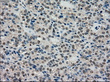 SCYL3 Antibody - IHC of paraffin-embedded Carcinoma of thyroid tissue using anti-SCYL3 mouse monoclonal antibody. (Dilution 1:50).