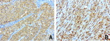 SDCBP / Syntenin Antibody - Immunohistochemical staining of paraffin-embedded composit of 2 human melanoma cases using anti-SDCBP clone UMAB69 mouse monoclonal antibody  at 1:100 with Polink2 Broad HRP DAB detection kit; heat-induced epitope retrieval with GBI Citrate pH6.0 HIER buffer using pressure chamber for 3 minutes at 110C. Membrane, nuclear, and cytoplasmic staining is seen in tumor cells with various intensity.