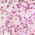 SDCCAG1 / NEMF Antibody - Immunohistochemical analysis of NEMF staining in human breast cancer formalin fixed paraffin embedded tissue section. The section was pre-treated using heat mediated antigen retrieval with sodium citrate buffer (pH 6.0). The section was then incubated with the antibody at room temperature and detected using an HRP conjugated compact polymer system. DAB was used as the chromogen. The section was then counterstained with hematoxylin and mounted with DPX.