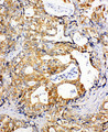 SDHC Antibody - SDHC antibody. IHC(P): Human Gastric Cancer Tissue.