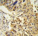 SDR / SDPR Antibody - SDR Antibody IHC of formalin-fixed and paraffin-embedded lung carcinoma followed by peroxidase-conjugated secondary antibody and DAB staining.