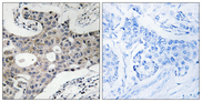 SEC16L / SEC16A Antibody - Immunohistochemistry analysis of paraffin-embedded human breast carcinoma, using SEC16A Antibody. The picture on the right is blocked with the synthesized peptide.