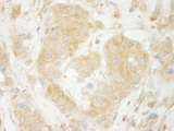 SEC23IP / p125 Antibody - Detection of Human Sec23IP(MSTP053) by Immunohistochemistry. Sample: FFPE section of human breast carcinoma. Antibody: Affinity purified rabbit anti- Sec23IP(MSTP053) used at a dilution of 1:200 (1 Detection: DAB.