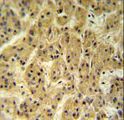 SEC24A Antibody - SC24A Antibody IHC of formalin-fixed and paraffin-embedded hepatocarcinoma followed by peroxidase-conjugated secondary antibody and DAB staining.