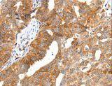 Secretin Antibody - Immunohistochemistry of paraffin-embedded Human ovarian cancer using SCT Polyclonal Antibody at dilution of 1:40.