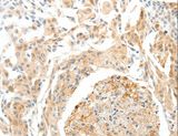 SEMA3D / Semaphorin 3D Antibody - Immunohistochemistry of paraffin-embedded Human cervical cancer using SEMA3D Polyclonal Antibody at dilution of 1:50.