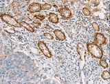 SEMA7A / Semaphorin 7A Antibody - Immunohistochemistry of paraffin-embedded Human lung cancer using SEMA7A Polyclonal Antibody at dilution of 1:35.