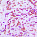 SENP8 Antibody - Immunohistochemical analysis of SENP8 staining in human breast cancer formalin fixed paraffin embedded tissue section. The section was pre-treated using heat mediated antigen retrieval with sodium citrate buffer (pH 6.0). The section was then incubated with the antibody at room temperature and detected using an HRP conjugated compact polymer system. DAB was used as the chromogen. The section was then counterstained with hematoxylin and mounted with DPX.