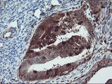 SERPINB1 Antibody - IHC of paraffin-embedded Adenocarcinoma of Human endometrium tissue using anti-SERPINB1 mouse monoclonal antibody. (Heat-induced epitope retrieval by 10mM citric buffer, pH6.0, 100C for 10min).