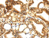 SERPINB1 Antibody - Immunohistochemistry of paraffin-embedded Human thyroid cancer using SERPINB1 Polyclonal Antibody at dilution of 1:30.