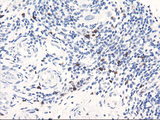 SERPINB2 / PAI-2 Antibody - IHC of paraffin-embedded Carcinoma of Human bladder tissue using anti-SERPINB2 mouse monoclonal antibody. (Heat-induced epitope retrieval by 10mM citric buffer, pH6.0, 100C for 10min).