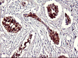 SERPINB3 Antibody - IHC of paraffin-embedded Carcinoma of Human bladder tissue using anti-SERPINB3 mouse monoclonal antibody. (Heat-induced epitope retrieval by 10mM citric buffer, pH6.0, 120°C for 3min).
