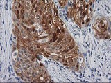 SERPINB4 / SCCA1+2 Antibody - IHC of paraffin-embedded Carcinoma of Human pancreas tissue using anti-SERPINB4 mouse monoclonal antibody.