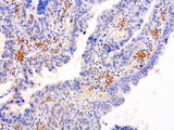 SERPINB4 / SCCA1+2 Antibody - Immunohistochemical staining of paraffin-embedded human gastric carcinoma using anti-SERPINB4 clone UMAB16 mouse monoclonal antibody  at 1:100 with Polink2 Broad HRP DAB detection kit; heat-induced epitope retrieval with GBI Accel pH8.7 HIER buffer using pressure chamber for 3 minutes at 110C. Cytoplasmic and membrane staining is seen in tumor cells.