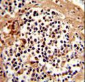 SERPINB7 / MEGSIN Antibody - Formalin-fixed and paraffin-embedded human kidney carcinoma reacted with SERPINB7 Antibody , which was peroxidase-conjugated to the secondary antibody, followed by DAB staining. This data demonstrates the use of this antibody for immunohistochemistry; clinical relevance has not been evaluated.