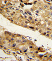 SERPINF1 / PEDF Antibody - Formalin-fixed and paraffin-embedded human hepatocarcinoma reacted with SERPINF1 Antibody , which was peroxidase-conjugated to the secondary antibody, followed by DAB staining. This data demonstrates the use of this antibody for immunohistochemistry; clinical relevance has not been evaluated.