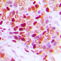 SF1 Antibody - Immunohistochemical analysis of SF1 (pS82) staining in human breast cancer formalin fixed paraffin embedded tissue section. The section was pre-treated using heat mediated antigen retrieval with sodium citrate buffer (pH 6.0). The section was then incubated with the antibody at room temperature and detected using an HRP conjugated compact polymer system. DAB was used as the chromogen. The section was then counterstained with hematoxylin and mounted with DPX.