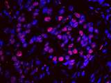 SF3A1 / SF3A120 Antibody - Detection of Human SF3a120/SAP114 by IHC-IF. Sample: FFPE section of human breast carcinoma. Antibody: Affinity purified rabbit anti-SF3a120/SAP114 used at a dilution of 1:100. Detection: Red-fluorescent goat anti-rabbit IgG highly cross-adsorbed Antibody used at a dilution of 1:100.