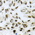 SF3B2 Antibody - Immunohistochemical analysis of SAP145 staining in human lung cancer formalin fixed paraffin embedded tissue section. The section was pre-treated using heat mediated antigen retrieval with sodium citrate buffer (pH 6.0). The section was then incubated with the antibody at room temperature and detected using an HRP conjugated compact polymer system. DAB was used as the chromogen. The section was then counterstained with hematoxylin and mounted with DPX.