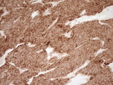 SFRP2 Antibody - IHC of paraffin-embedded Carcinoma of Human lung tissue using anti-SFRP2 mouse monoclonal antibody. (Heat-induced epitope retrieval by 1 mM EDTA in 10mM Tris, pH8.5, 120°C for 3min).
