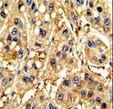 SFRP5 Antibody - Formalin-fixed and paraffin-embedded human hepatocarcinoma with SFRP5 Antibody , which was peroxidase-conjugated to the secondary antibody, followed by DAB staining. This data demonstrates the use of this antibody for immunohistochemistry; clinical relevance has not been evaluated.