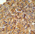 SFT2D3 Antibody - SFT2D3 Antibody IHC of formalin-fixed and paraffin-embedded human hepatocarcinoma followed by peroxidase-conjugated secondary antibody and DAB staining.