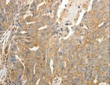 SFTPD / Surfactant Protein D Antibody - Immunohistochemistry of paraffin-embedded Human ovarian cancer using SFTPD Polyclonal Antibody at dilution of 1:30.
