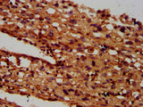 SGCB / SGC / Sarcoglycan Beta Antibody - Immunohistochemistry Dilution at 1:600 and staining in paraffin-embedded human melanoma cancer performed on a Leica BondTM system. After dewaxing and hydration, antigen retrieval was mediated by high pressure in a citrate buffer (pH 6.0). Section was blocked with 10% normal Goat serum 30min at RT. Then primary antibody (1% BSA) was incubated at 4°C overnight. The primary is detected by a biotinylated Secondary antibody and visualized using an HRP conjugated SP system.