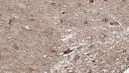 SGCB / SGC / Sarcoglycan Beta Antibody - 1:100 staining human brain carcinoma tissue by IHC-P. The sample was formaldehyde fixed and a heat mediated antigen retrieval step in citrate buffer was performed. The sample was then blocked and incubated with the antibody for 1.5 hours at 22°C. An HRP conjugated goat anti-rabbit antibody was used as the secondary.