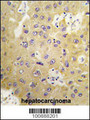 SGK3 Antibody - Formalin-fixed and paraffin-embedded human hepatocarcinoma tissue reacted with SGK3 Antibody , which was peroxidase-conjugated to the secondary antibody, followed by DAB staining. This data demonstrates the use of this antibody for immunohistochemistry; clinical relevance has not been evaluated.