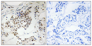 SGOL2 Antibody - Immunohistochemistry analysis of paraffin-embedded human breast carcinoma, using SGOL2 Antibody. The picture on the right is blocked with the synthesized peptide.