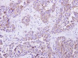 SGTA / SGT Antibody - SGTA antibody detects SGTA protein at cytosol on Lung adenocarcinoma by immunohistochemical analysis. Sample: Paraffin-embedded Lung adenocarcinoma. SGTA antibody dilution:1:500.