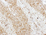 SH3GL1 / EEN Antibody - IHC of paraffin-embedded Breast ca using EEN antibody at 1:250 dilution.