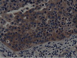 SH3GL1 / EEN Antibody - IHC of paraffin-embedded Carcinoma of Human bladder tissue using anti-SH3GL1 mouse monoclonal antibody.
