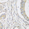 SH3GLB2 / Endophilin-B2 Antibody - Immunohistochemistry of paraffin-embedded human colon carcinoma tissue.