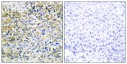 SHPK / CARKL Antibody - Immunohistochemistry analysis of paraffin-embedded human liver carcinoma tissue, using CARKL Antibody. The picture on the right is blocked with the synthesized peptide.