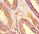 SHROOM3 Antibody - Immunohistochemistry of paraffin-embedded human endometrial cancer at dilution of 1:100