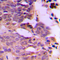 SIAH1/SIAH2 Antibody - Immunohistochemical analysis of SIAH1/2 staining in human breast cancer formalin fixed paraffin embedded tissue section. The section was pre-treated using heat mediated antigen retrieval with sodium citrate buffer (pH 6.0). The section was then incubated with the antibody at room temperature and detected using an HRP conjugated compact polymer system. DAB was used as the chromogen. The section was then counterstained with hematoxylin and mounted with DPX.