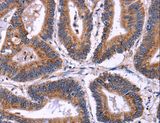 SIGLEC5 / CD170 Antibody - Immunohistochemistry of paraffin-embedded Human colon cancer using SIGLEC5 Polyclonal Antibody at dilution of 1:30.