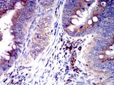 SIGLEC6 Antibody - Immunohistochemical analysis of paraffin-embedded rectum cancer tissues using CD327 mouse mAb with DAB staining.